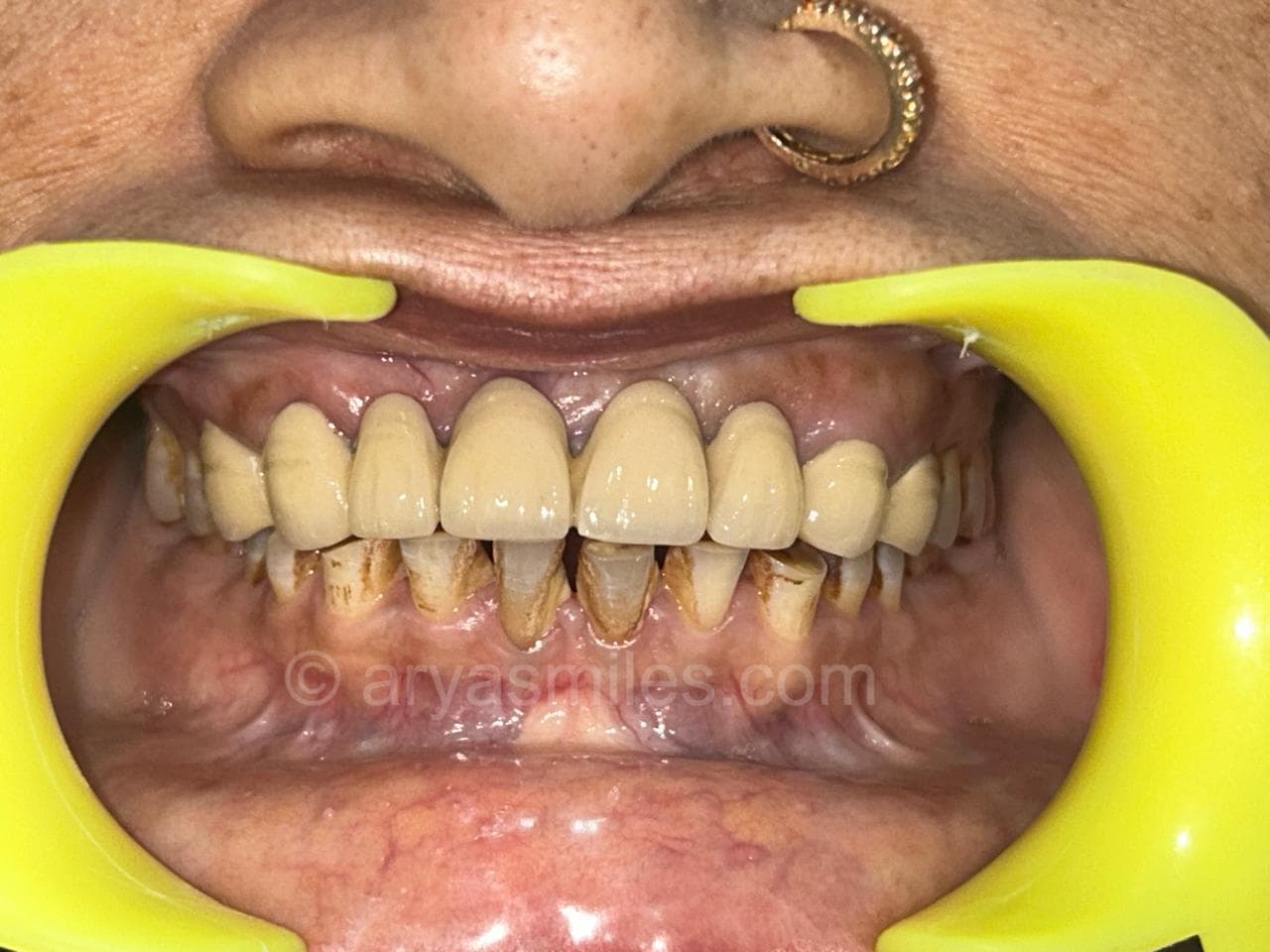 After: Smile Rehabilitation