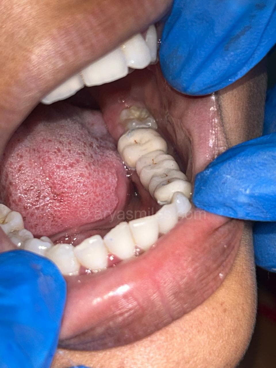After: Fixed Partial Denture