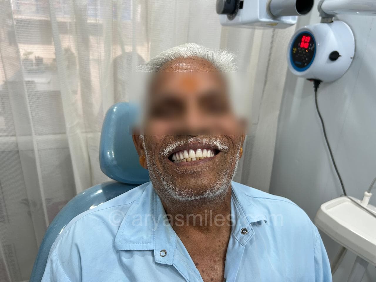 After: Smile Makeover