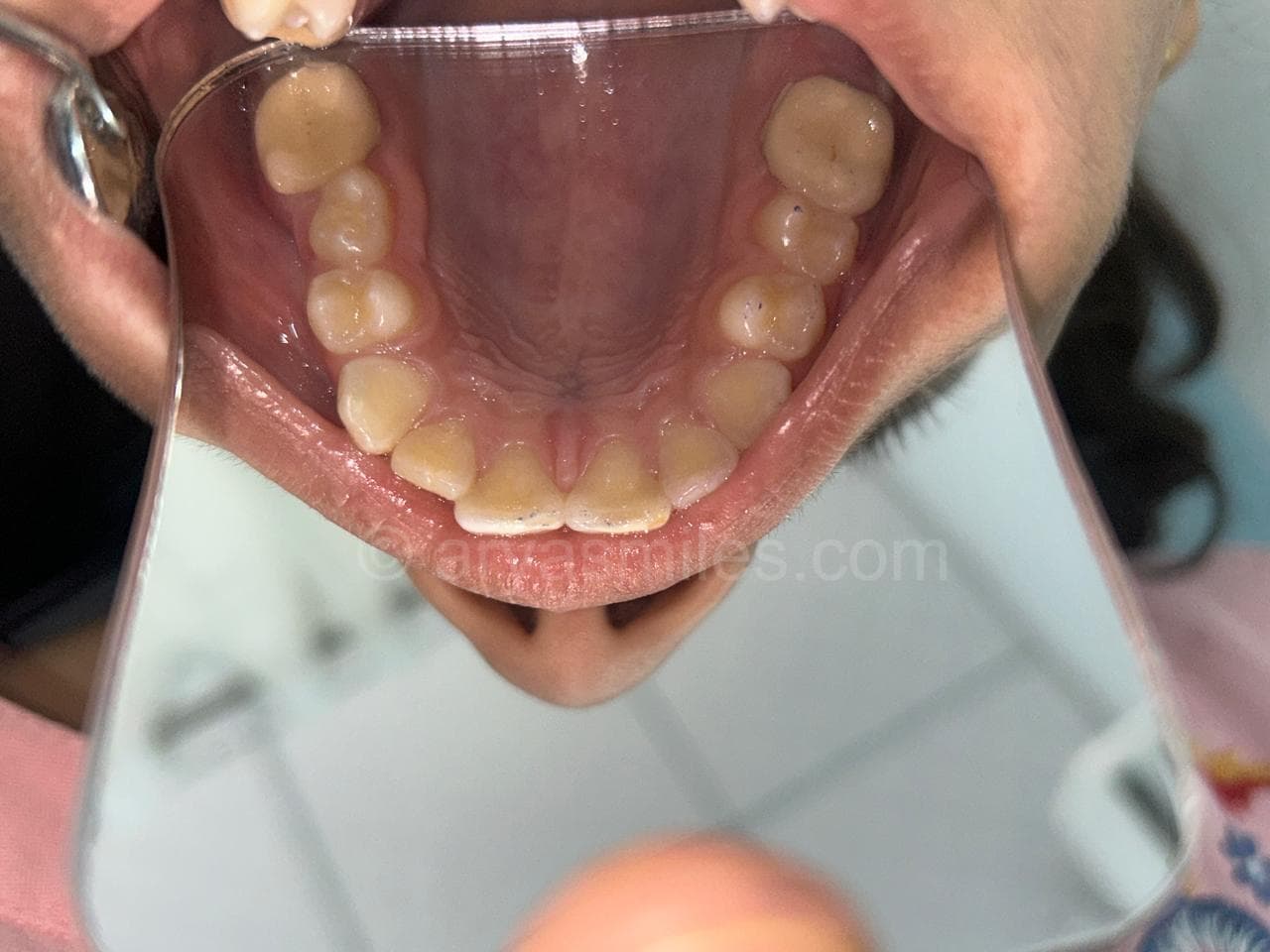 After: Endo and Prostho Treatment