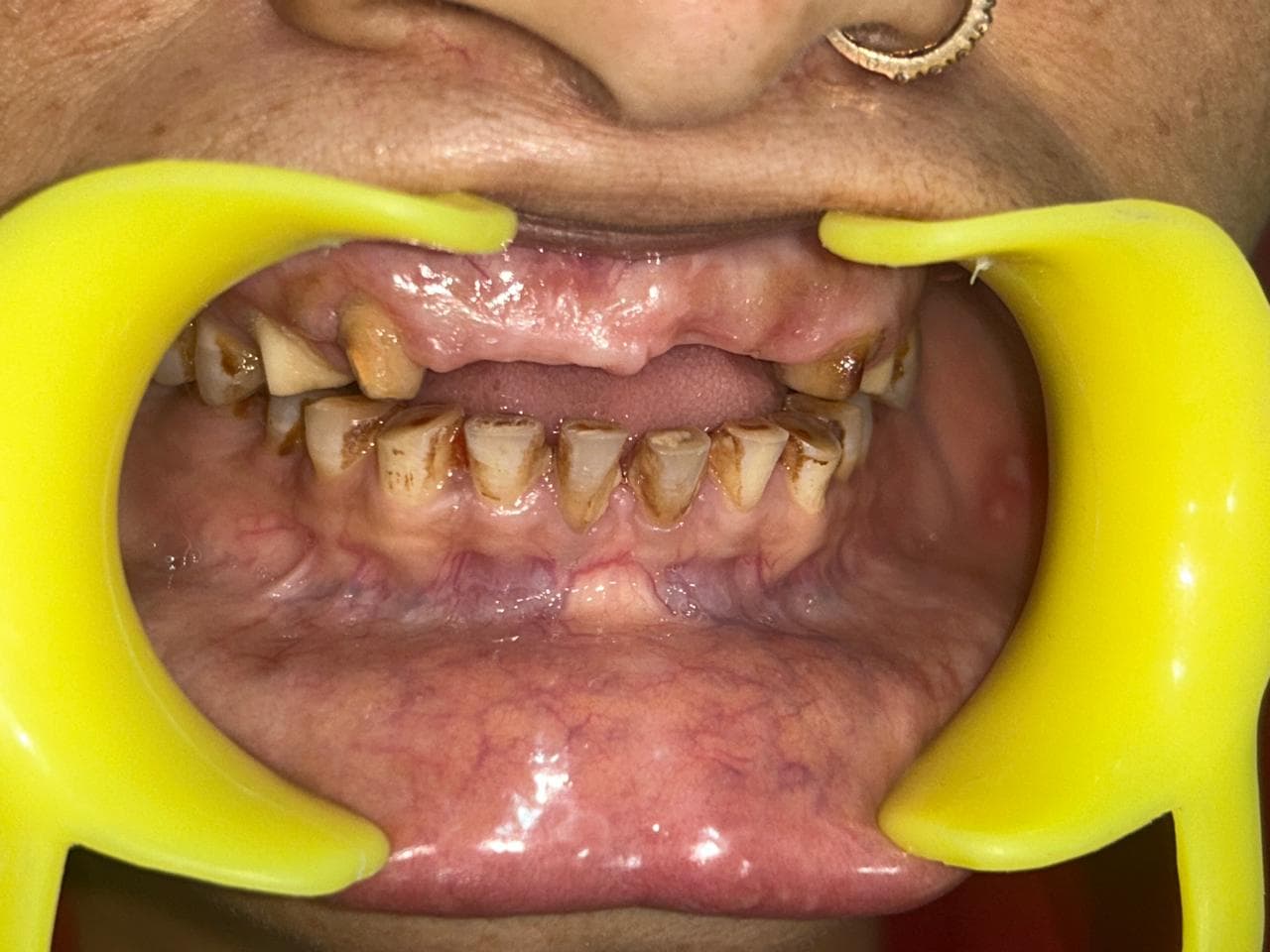 Before: Smile Rehabilitation