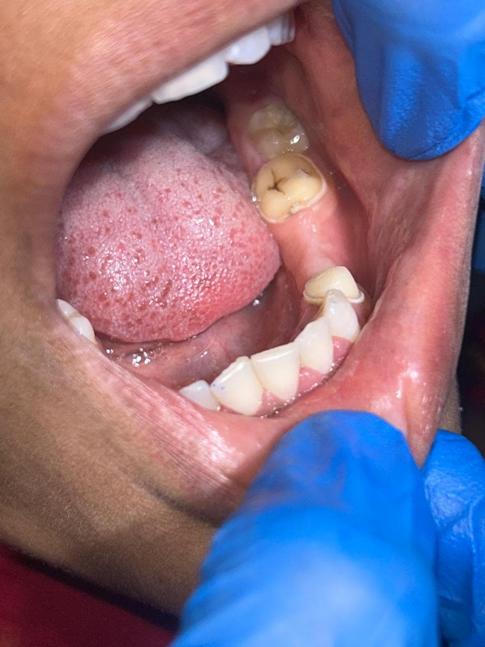 Before: Fixed Partial Denture