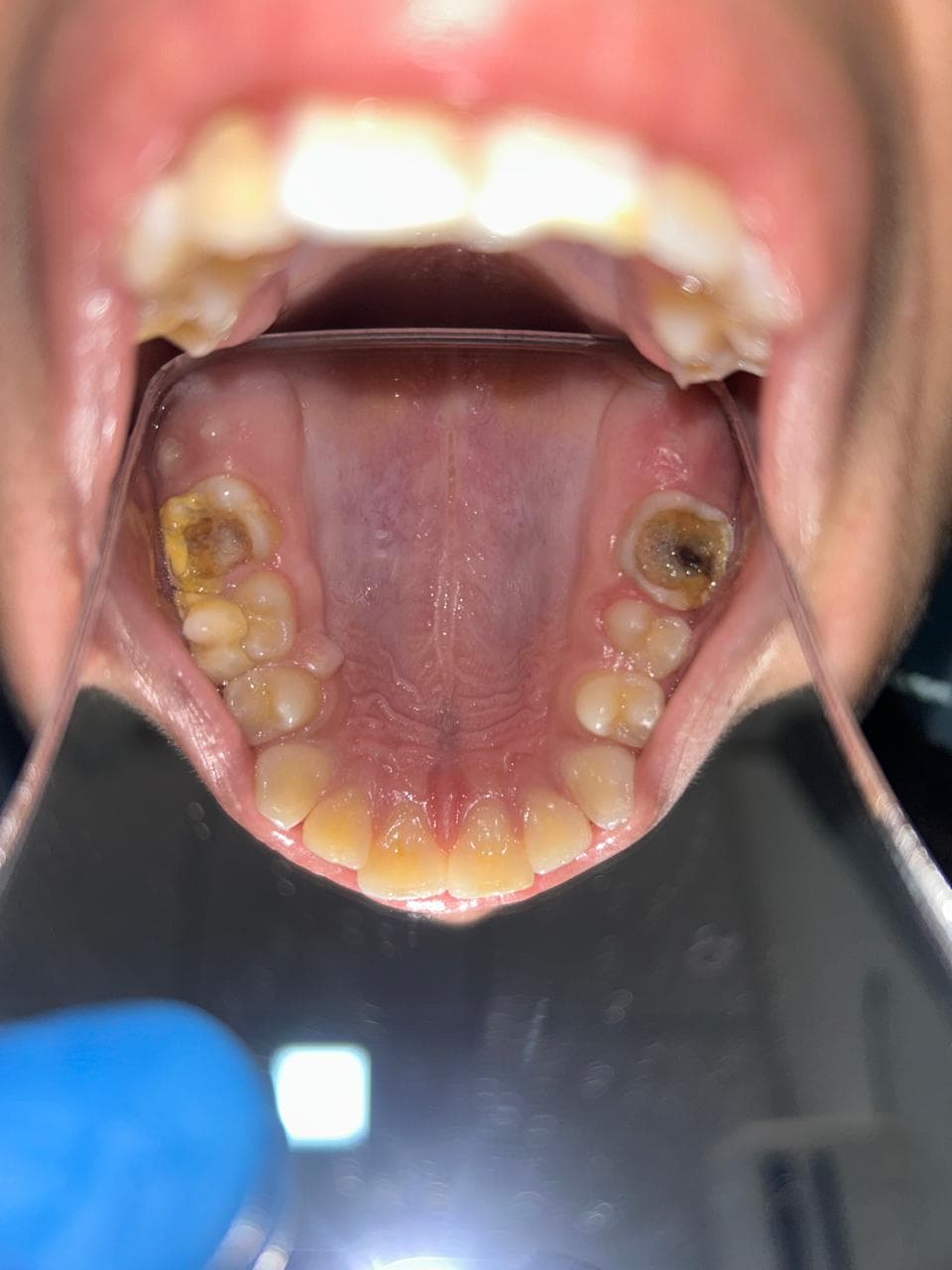 Before: Endo and Prostho Treatment
